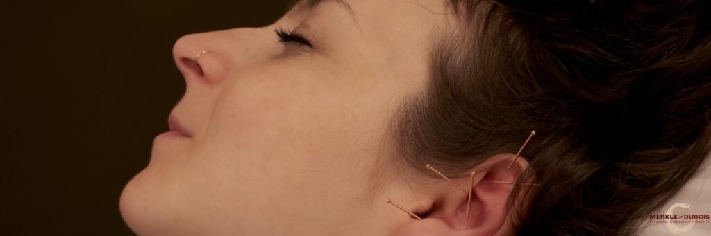 Akupunktur Behandlung | Akupunktur Basel | Merkle Dubois TCM Praxis Basel