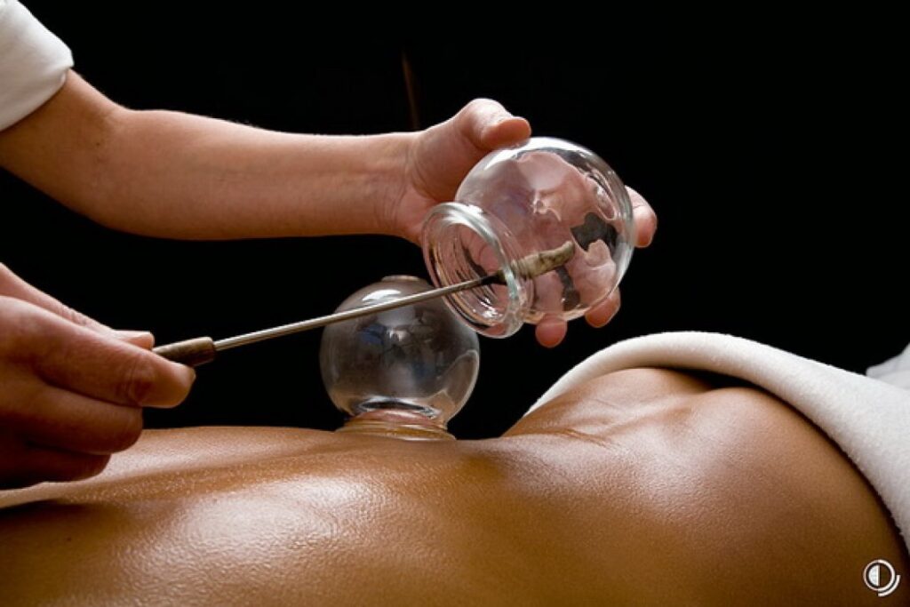 Schröpfen | Merkle Dubois TCM Praxis Basel