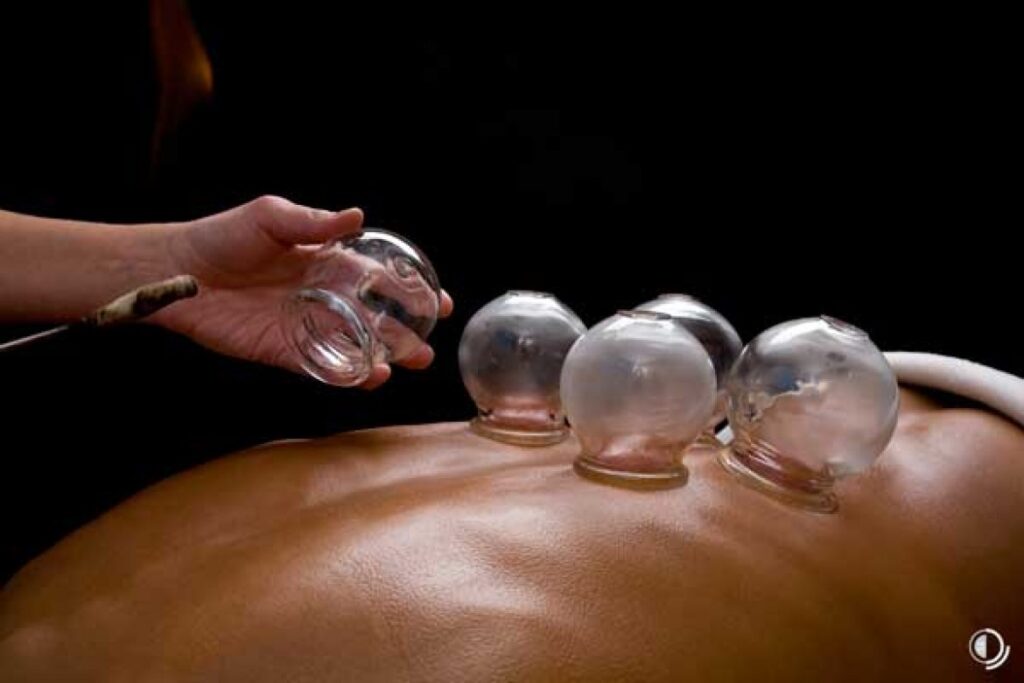 Schröpfen | Merkle Dubois TCM Praxis Basel